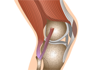 무릎(슬관절) 인공관절 수술