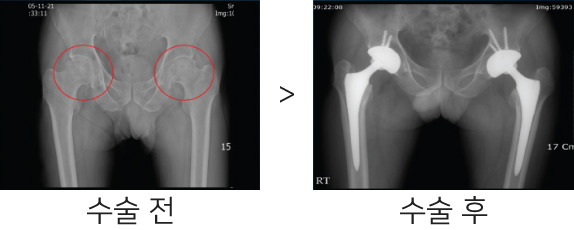 고관절 인공관절 수술 전후 비교 엑스레이 사진