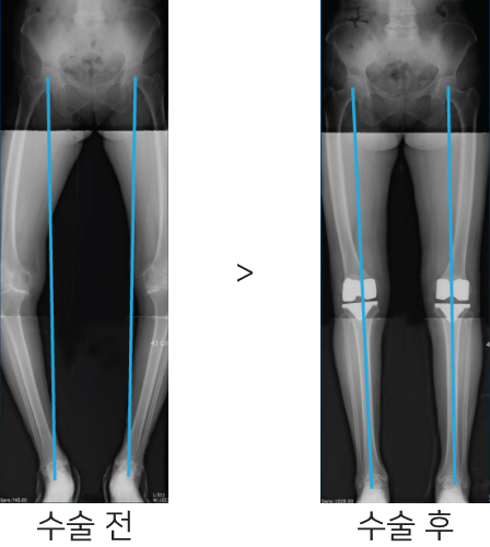 무릎 인공관절 수술 전후 비교 엑스레이 사진